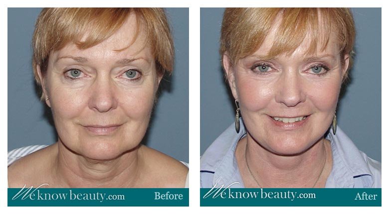 Facelift