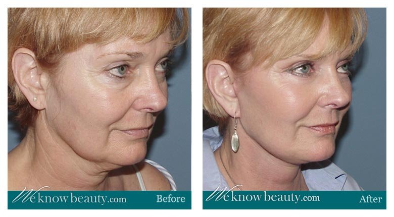Facelift