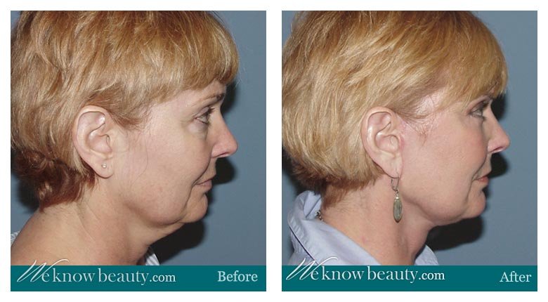 Facelift