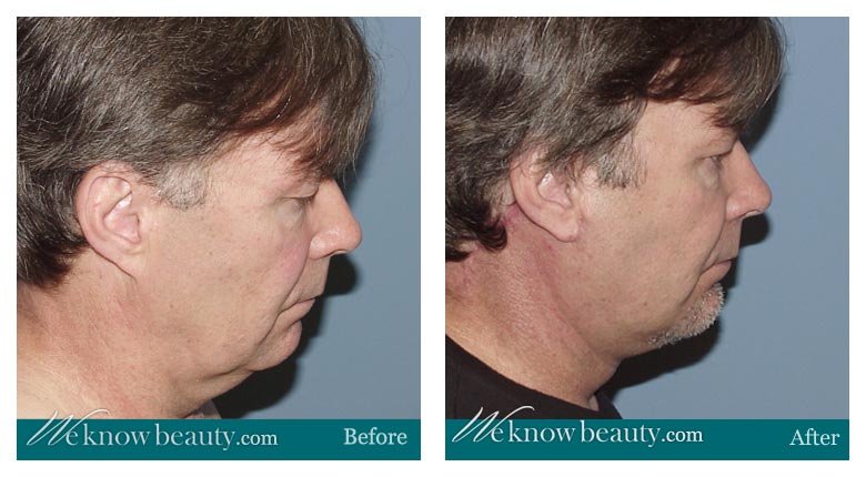 Neck Lift