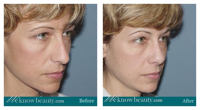 Rhinoplasty