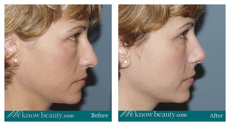 Rhinoplasty