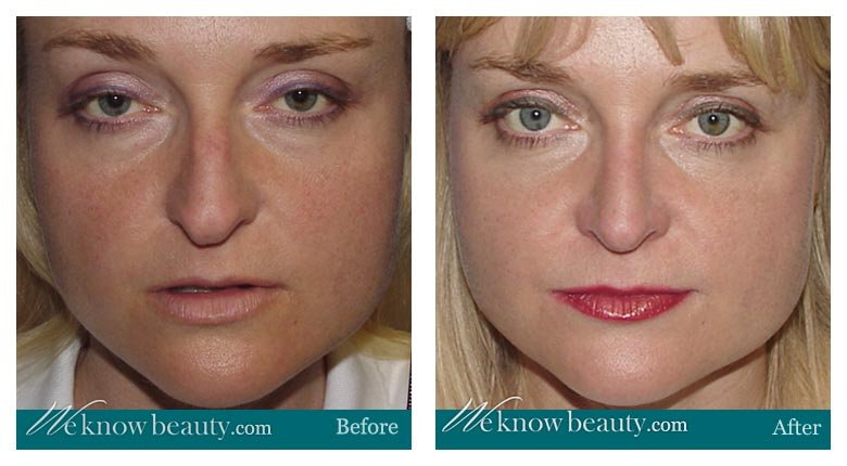 Rhinoplasty