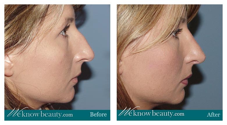 Rhinoplasty